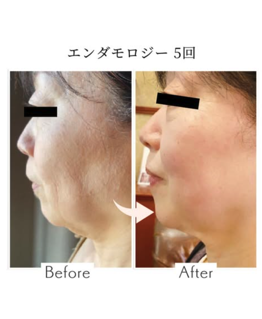 ファシオールの施術前後の肌状態比較例